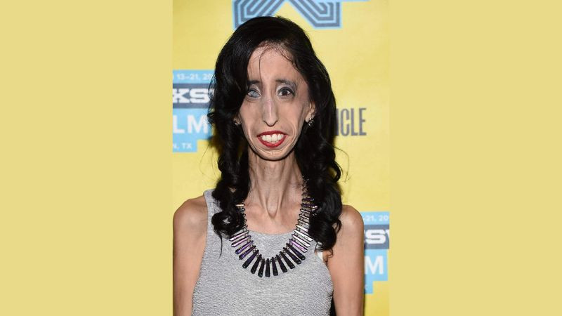 Chân dung Lizzie Velasquez