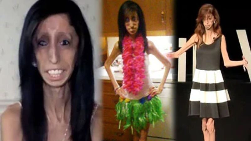 Lizzie Velasquez tương tác với mọi người