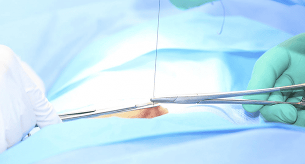 Quá trình tự tiêu của chỉ khâu tầng sinh môn và sự hồi phục tự nhiên của vết thương