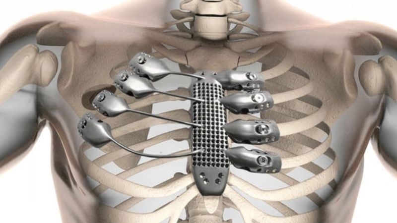 Trụ cấy ghép răng (implant) bằng vật liệu Titan, minh chứng cho tính tương thích sinh học cao trong y học