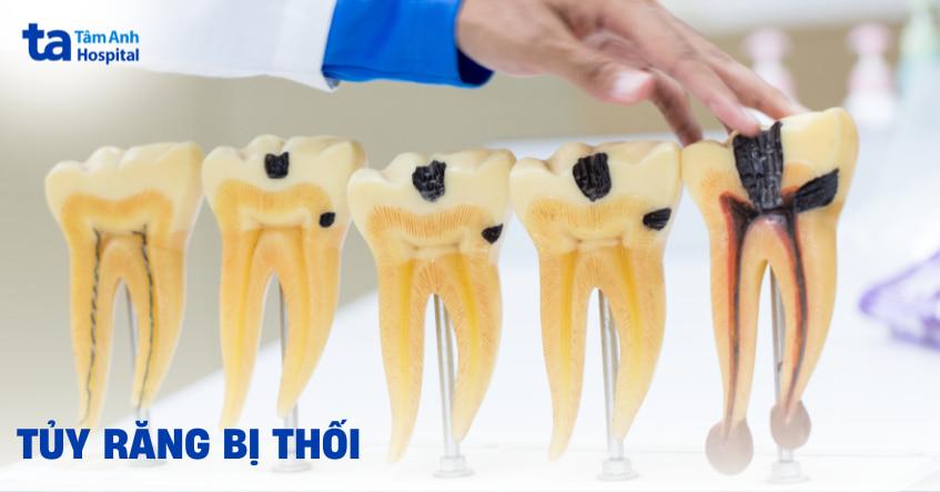 Hinh anh tuy rang bi hoai tu mau xam den do ton thuong