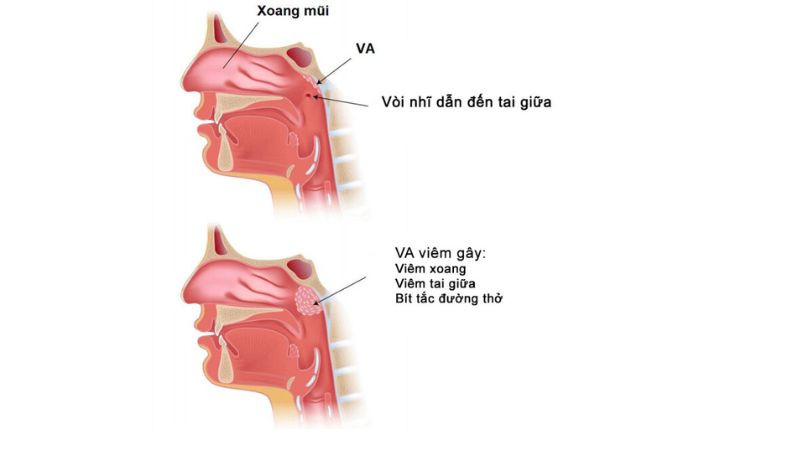 Viêm VA Là Gì? Triệu Chứng, Nguyên Nhân Và Cách Điều Trị Hiệu Quả