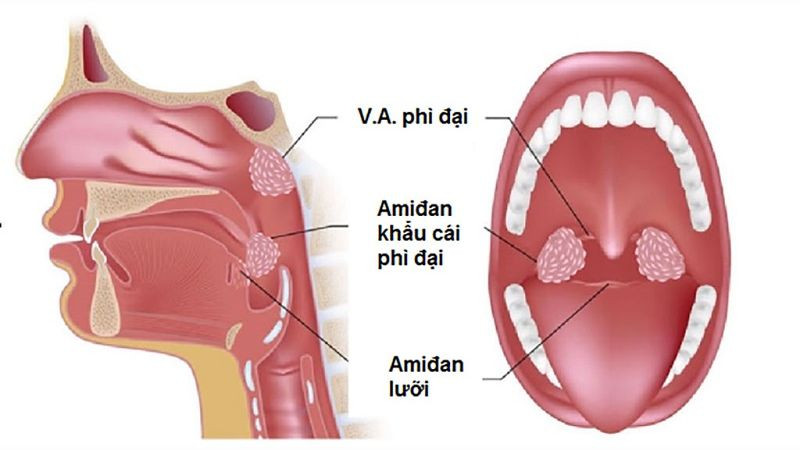 Viêm VA Là Gì? Triệu Chứng, Nguyên Nhân Và Cách Điều Trị Hiệu Quả