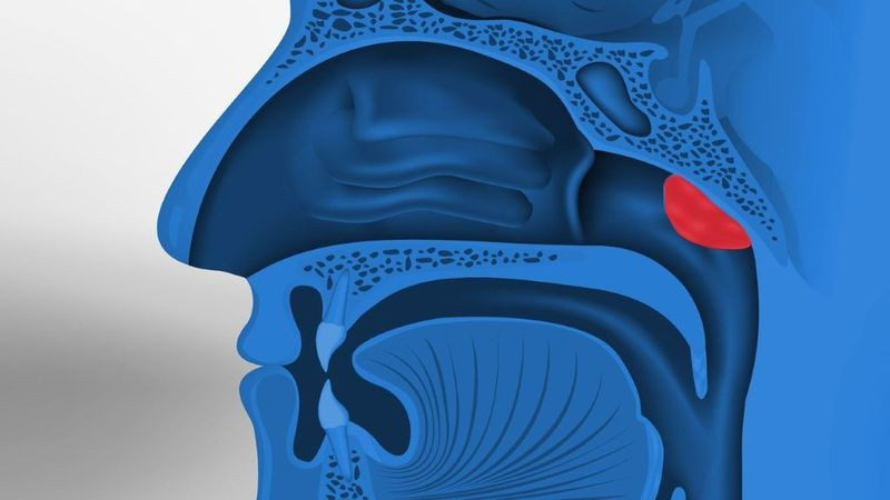 Viêm VA Là Gì? Triệu Chứng, Nguyên Nhân Và Cách Điều Trị Hiệu Quả