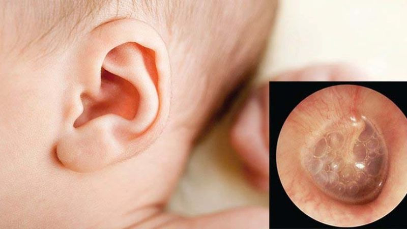 Viêm VA Là Gì? Triệu Chứng, Nguyên Nhân Và Cách Điều Trị Hiệu Quả