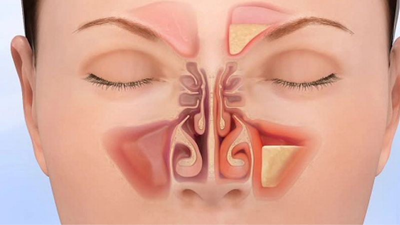 Viêm VA Là Gì? Triệu Chứng, Nguyên Nhân Và Cách Điều Trị Hiệu Quả