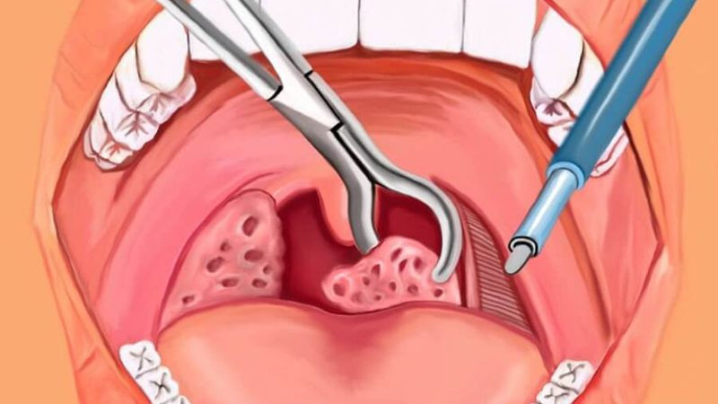 Viêm VA Là Gì? Triệu Chứng, Nguyên Nhân Và Cách Điều Trị Hiệu Quả