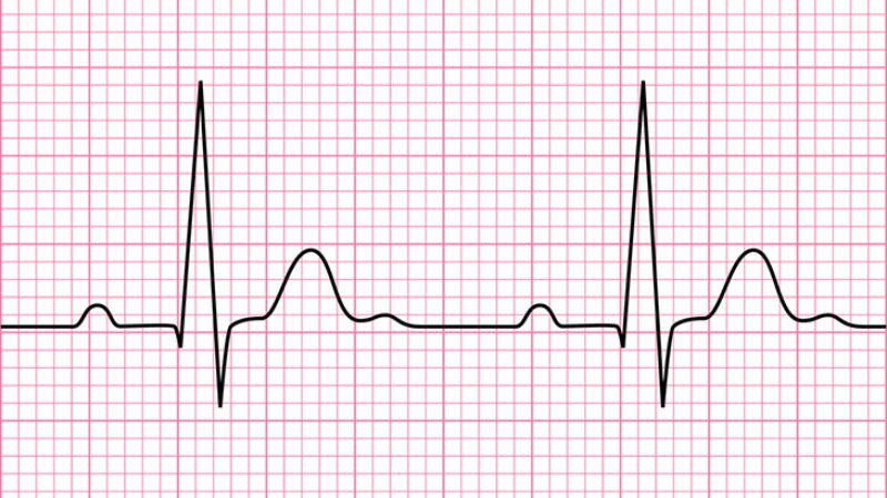 Đồ thị điện tâm đồ (ECG) ghi lại hoạt động điện của tim