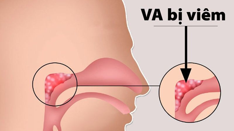 Viêm VA Là Gì? Triệu Chứng, Nguyên Nhân Và Cách Điều Trị Hiệu Quả